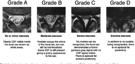 Lumbar spinal stenosis (grading) .